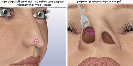 Consecințe după rinoplastie - edeme, vânătăi și cicatrici