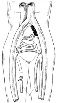 Sindromul post-tromboflebitic