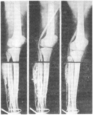 Sindromul post-tromboflebitic