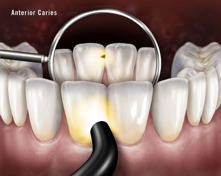 Поверхневий карієс особливості, симптоми і лікування
