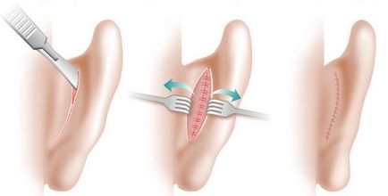 Otoplastia repetată provoacă o funcționare nereușită