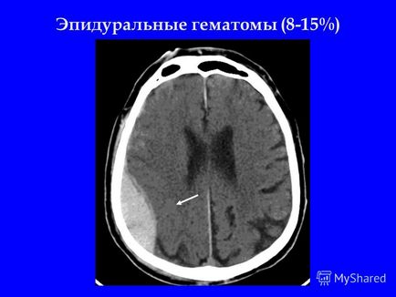 Prezentare pe tema diagnosticului de radiație a traumatismelor craniocerebrale, tomografie computerizată