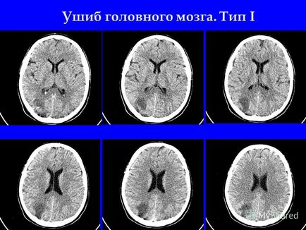 Prezentare pe tema diagnosticului de radiație a traumatismelor craniocerebrale, tomografie computerizată