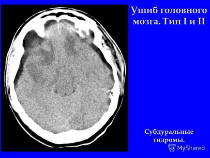 Prezentare pe tema diagnosticului de radiație a traumatismelor craniocerebrale, tomografie computerizată