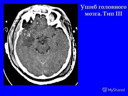 Презентація на тему променева діагностика черепно-мозкової травми комп'ютерна томографія