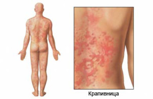 Az okok urticaria és angioödéma