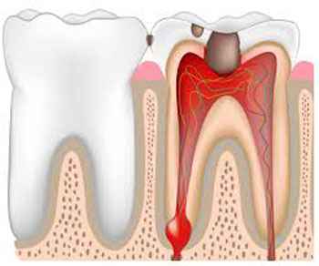 Pulpitul dintelui ce este, simptomele și tratamentul pulpitei (foto)