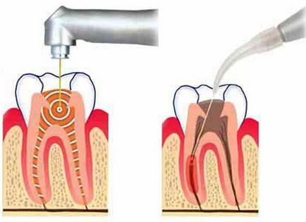 Pulpitul dintelui ce este, simptomele și tratamentul pulpitei (foto)
