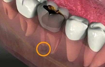 Пульпіт зуба що це таке, пульпіт симптоми і лікування (фото)