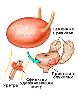 Radical prostatectomy - recomandări pentru pacienții care au suferit intervenții chirurgicale, uronews