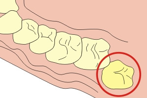 Ріжеться зуб мудрості які виникають симптоми, показання до видалення