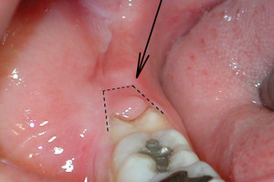 Ріжеться зуб мудрості які виникають симптоми, показання до видалення