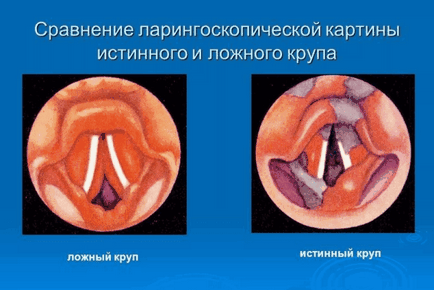 Сильний сухий кашель у дорослого і дитини лікувати протівоотахрківающімі, муколітики, що робити,