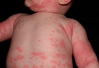 Allergiás tünetek - Homeopátiás Clinic „abriell”