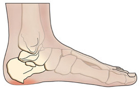 Simptomele bolii calcaneale și tratamentul acesteia