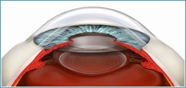Скільки коштує операція на очі - короткозорість (міопія)