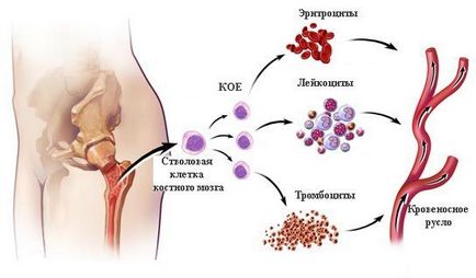 Simptomele mielozelor subleucemice, semnele, diagnosticul și tratamentul