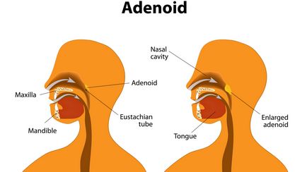 Adenoidectomy Moszkva, árak, véleménye a klinikák