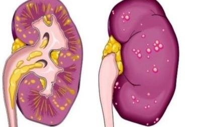 Eliminarea chistului renal (laparoscopie) ca operație și dacă este necesar