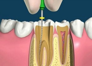 Eliminarea nervului din indicațiile dintelui și metodele de depoluare