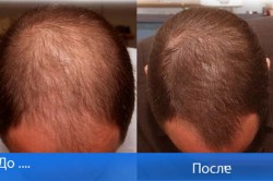 Indicații cu privire la pulverizarea părului cu ultrasunete pentru utilizare și mărturiile clienților despre acest medicament