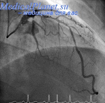 Controlul ritmului cardiac