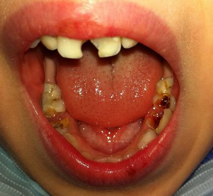 A gyermek szaga száj rothadás betegséget okoz tüneteket, veszély