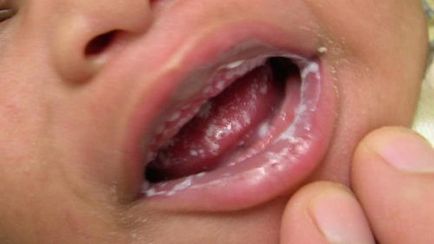 Copilul miroase din gura cauzelor de putregai, simptome de boală, pericol
