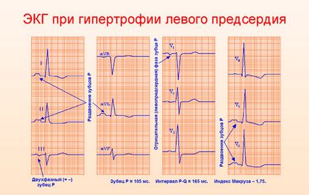 Збільшення порожнини лівого передсердя що це таке і чим загрожує