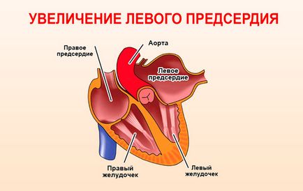 Збільшення порожнини лівого передсердя що це таке і чим загрожує