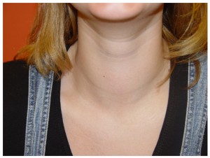 Simptome de extindere a tiroidei