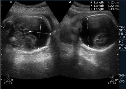 Fetal uzi