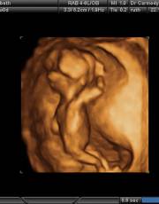 Ecografia fetală în timpul sarcinii - sarcină