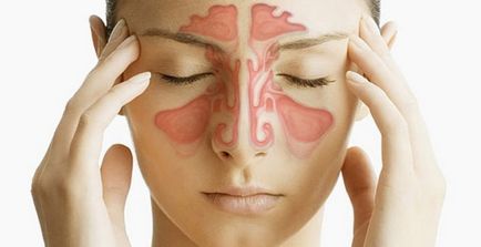 Tipuri de sinuzită, tratamentul sinuzitei