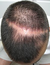 Căderea părului (alopecie) - păr - articole - clinică medicală pentru tratamentul și creșterea părului an-farm