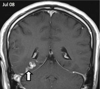 În creierul unui om patru ani a trăit un vierme parazit rare - boli și mutații - știri