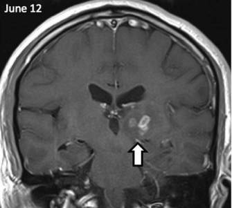 У мозку чоловіка чотири роки жив рідкісний черв'як-паразит - хвороби і мутації - новини
