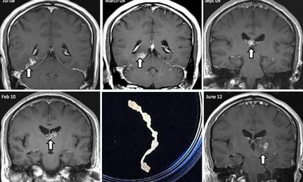 У мозку чоловіка чотири роки жив рідкісний черв'як-паразит - хвороби і мутації - новини