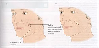 Excizia chirurgicală a cicatricilor, caracteristici de operare pentru excitarea cicatricilor