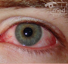 Chlamydia szem kezelésére, a szemészet, a Nemzetközi Egészségügyi Központ, Metro Dostoevskaya