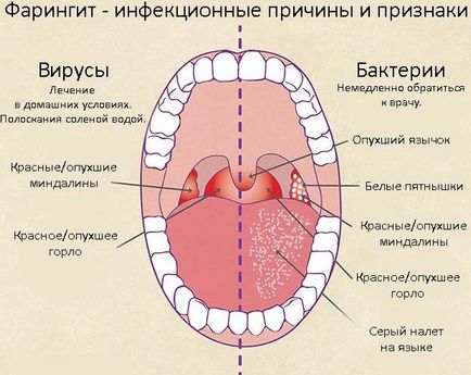 Хронічні ускладнення після фарингіту у дорослих і дітей на вухо, язик, горло