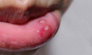 Boli ale cavității orale a simptomelor și tratamentelor umane adulte