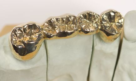 Золоті зуби більше не потрібні