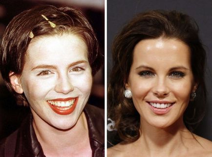 Fogak hollywoodi híresség utazás előtt és után a fogorvos, umkra (fogak csillag) Fogak hollywoodi híresség utazás előtt és után a fogorvos, umkra