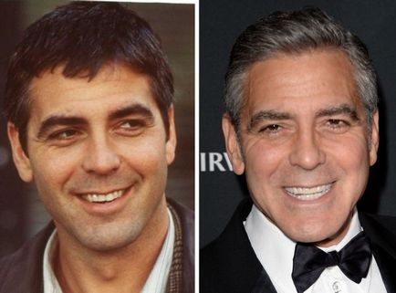 Зуби голлівудських знаменитостей до і після відвідин стоматолога, умкра