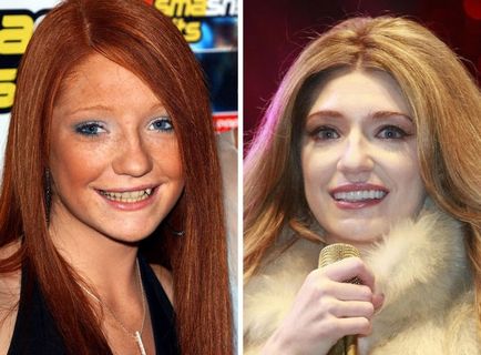 Fogak hollywoodi híresség utazás előtt és után a fogorvos, umkra (Celebrity fogak előtt és után) Fogak hollywoodi híresség utazás előtt és után a fogorvos, umkra