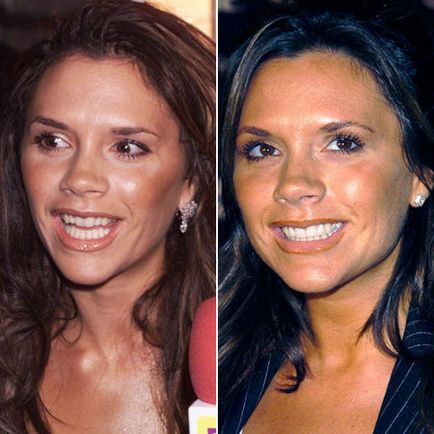 Зуби зірок до і після фотографії