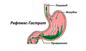 Антрални гастрит симптоми, диагностика, лечение и диета