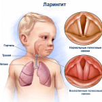 Berodual și pulmicort cu laringită la copii pentru dozare, durată și recenzii
