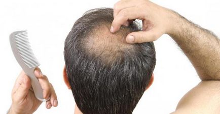 Alopecia îngrijorează învățarea tuturor despre cauzele acestui fenomen